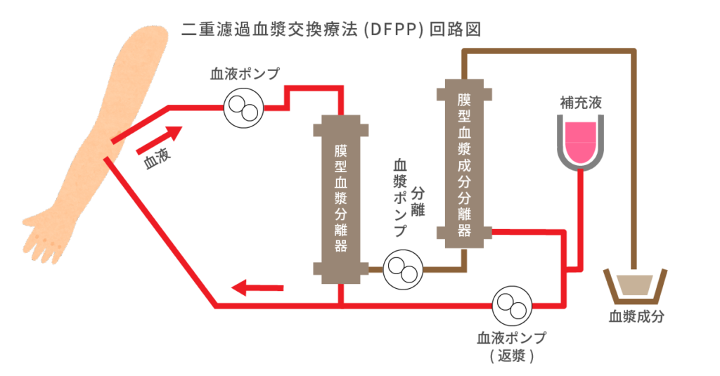 二重濾過血漿交換療法(DFPP)回路図