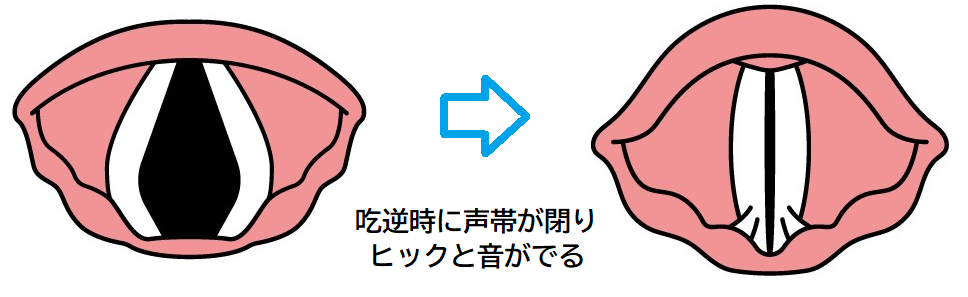 吃逆（しゃっくり）の多彩な原因と様々な対処法 – 舘内記念診療所